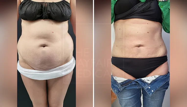 Liposuction Before And After Patients Photos Gallery