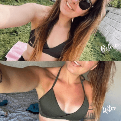 boob job before and after