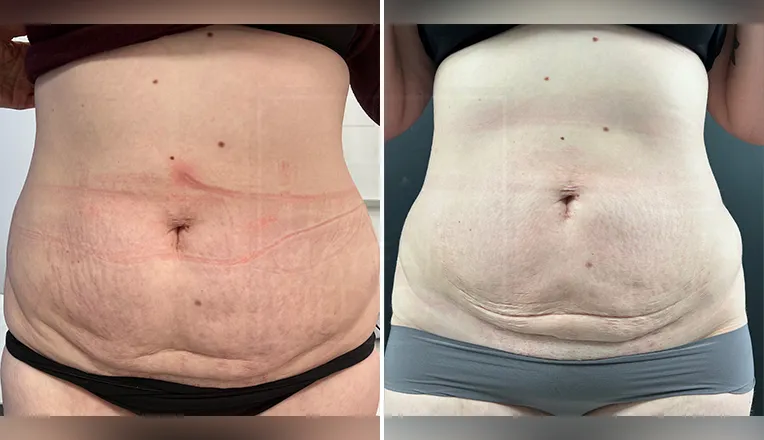abdominal vaser liposuction before and after
