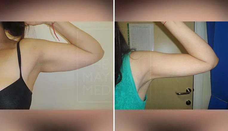 arm liposuction before and after patient-1-1