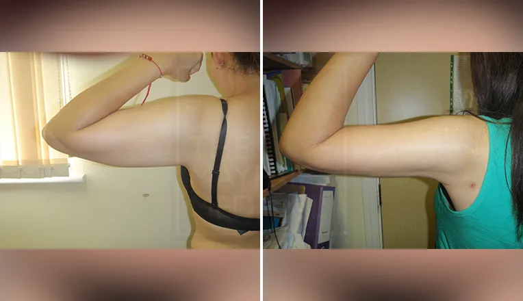 arm liposuction before and after patient-1-2