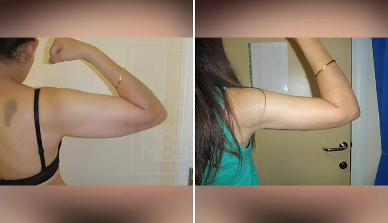 arm liposuction before and after patient-1-3