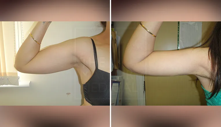 arm liposuction before and after patient-1