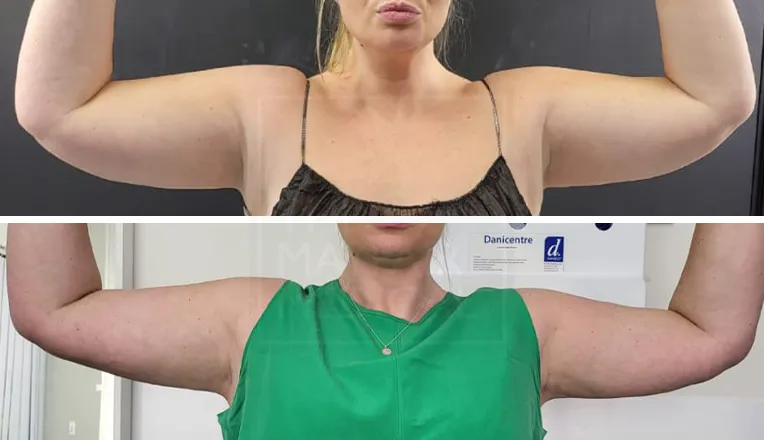 arm liposuction before and after patient-2