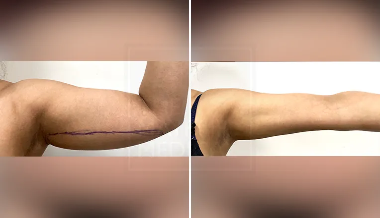 arm liposuction before and after