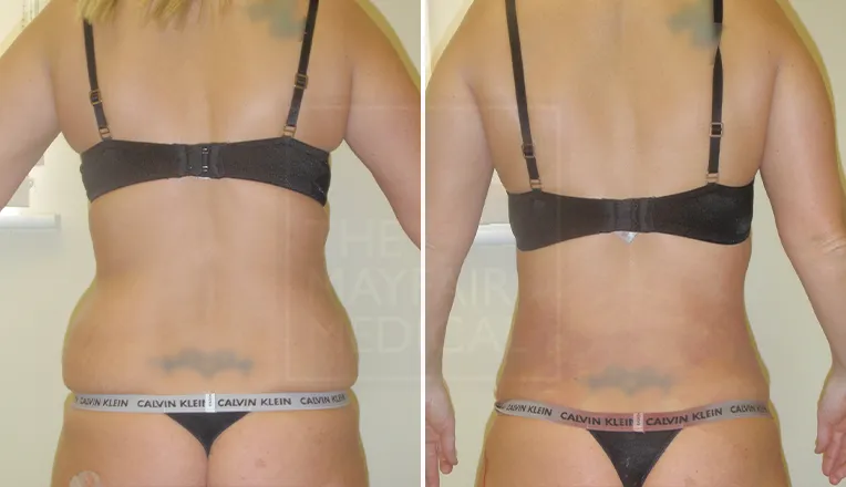 back fat liposuction before and after