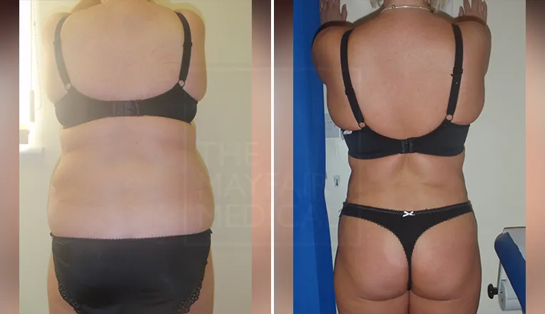 back liposuction before and after