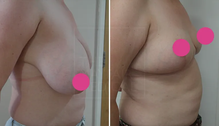 before and after breast reduction-3