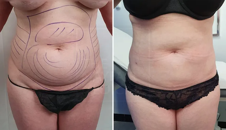 belly liposuction before and after