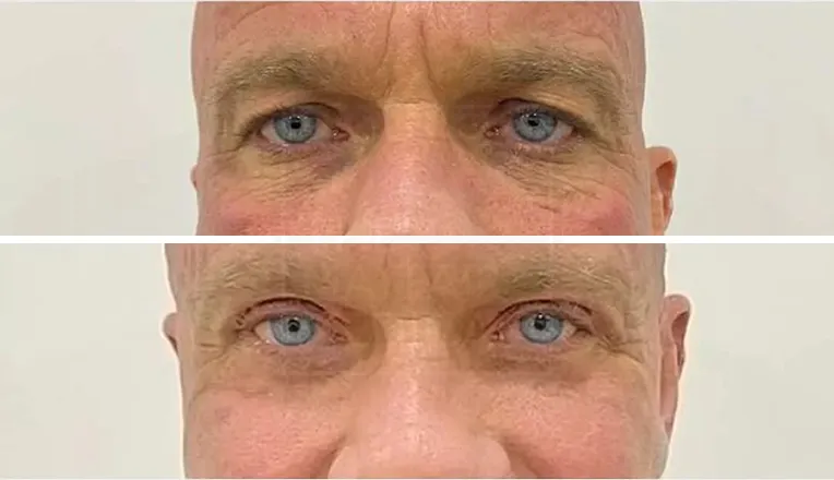blepharoplasty before and after men