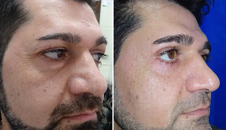blepharoplasty before and after patient-1-1