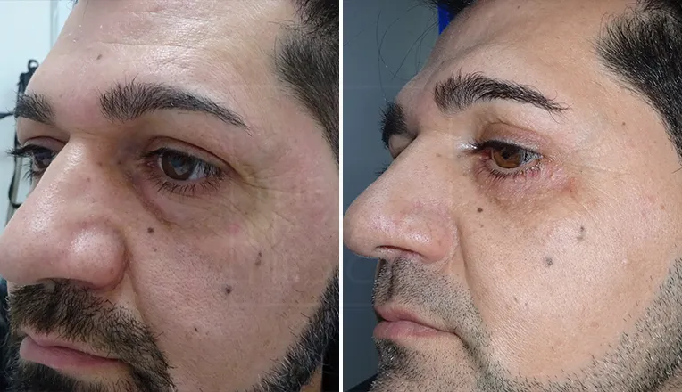 blepharoplasty before and after patient-1