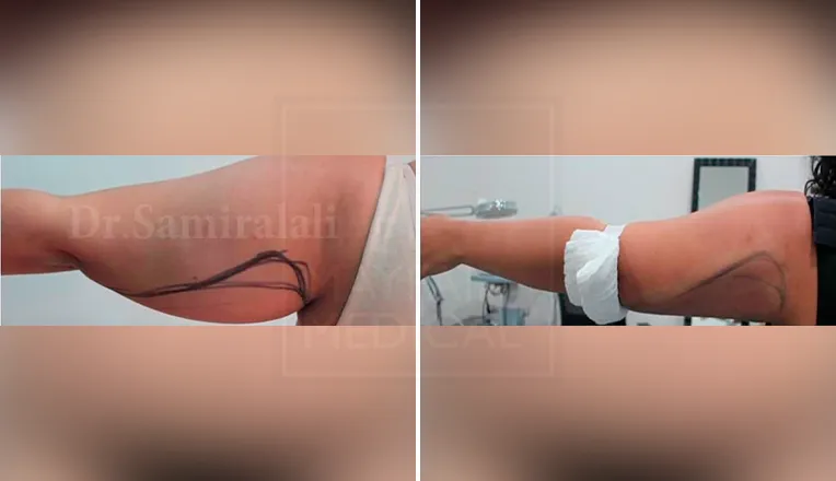 brachioplasty arm lift before and after