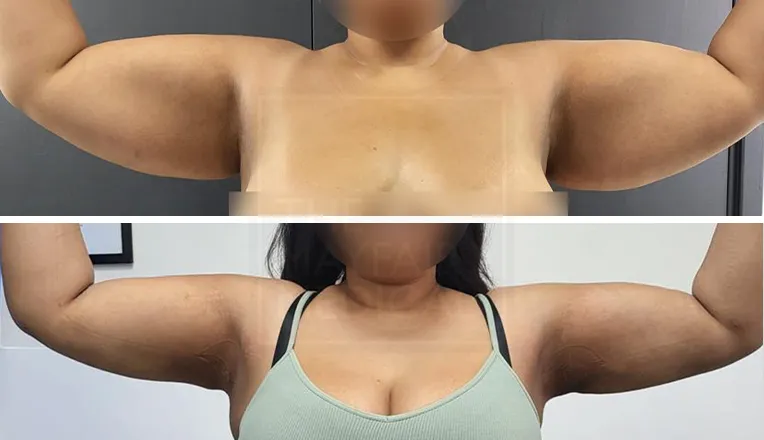 brachioplasty before and after-3