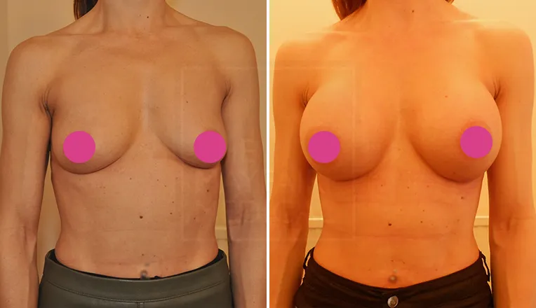 breast augmentation before and after-1