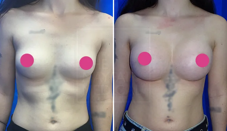 breast augmentation before and after result-1