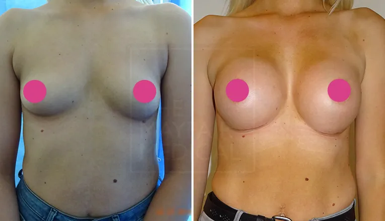 breast augmentation before and after result