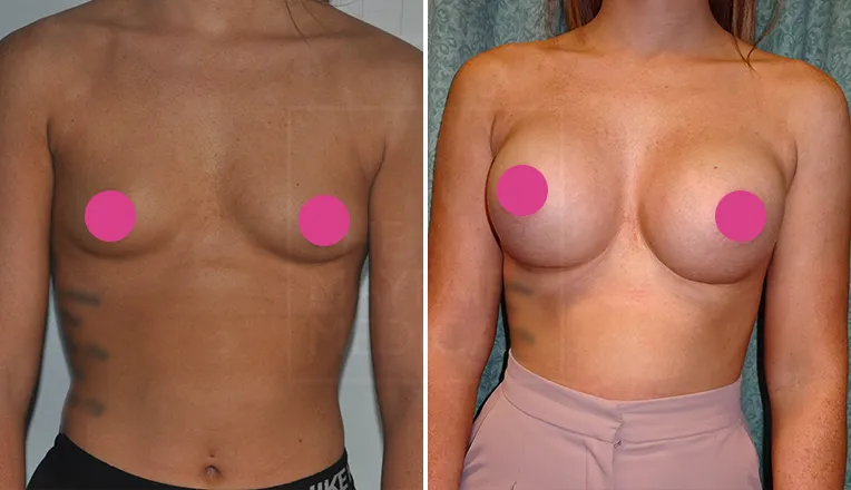 breast augmentation surgery before and after-1
