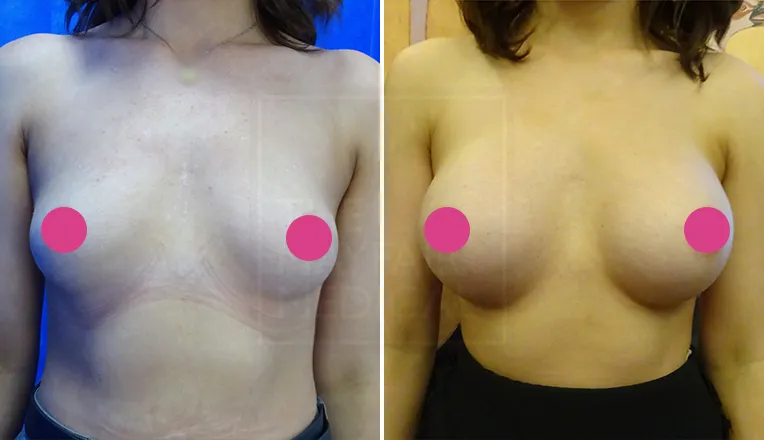 breast enlargement before and after-1