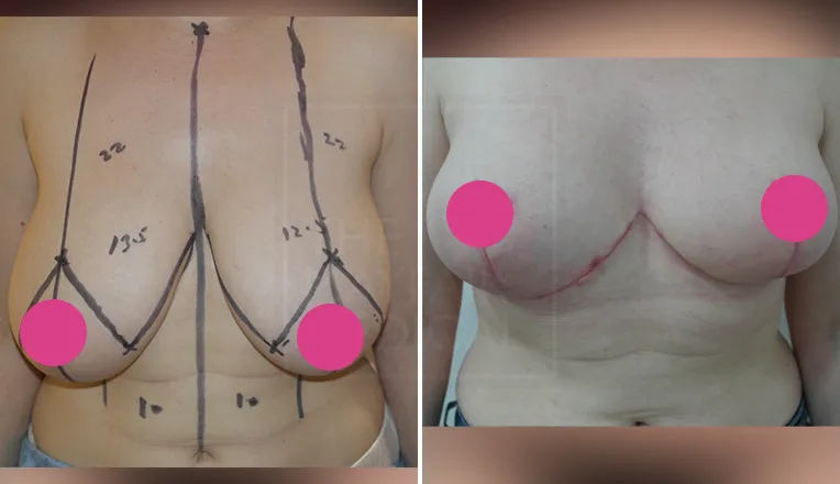 breast reduction before and after-1