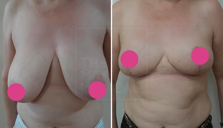 breast reduction before and after-3