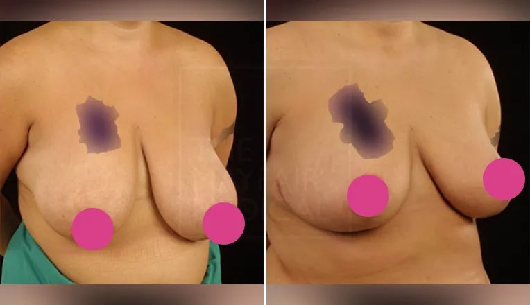 breast reduction before and after patient-2
