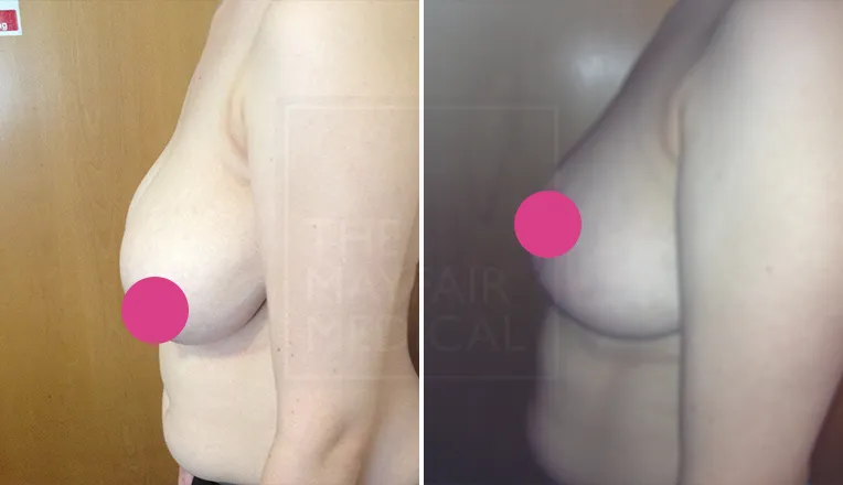 breast reduction surgery before and after-1