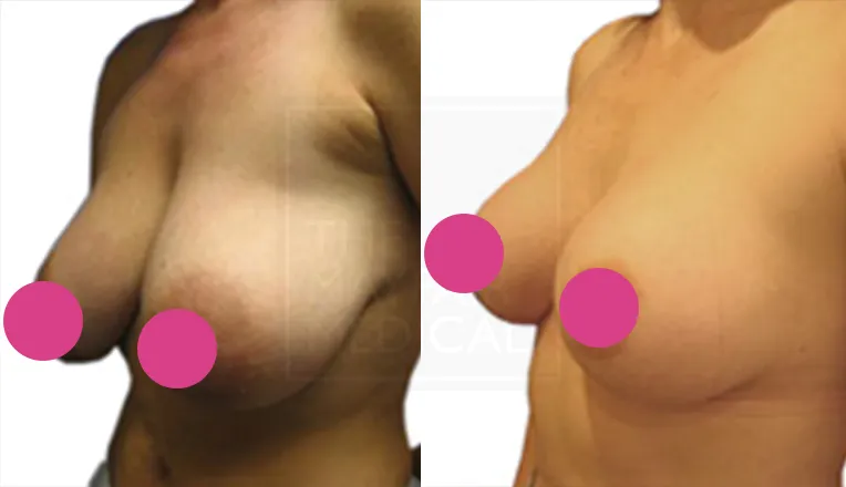 breast reduction surgery before and after patient-1