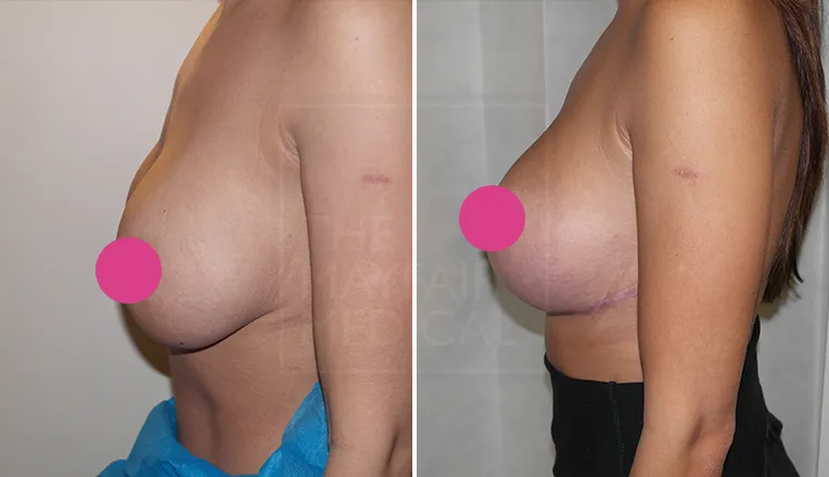 breast uplift before and after patient-3-1