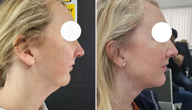 chin liposuction before and afte-1