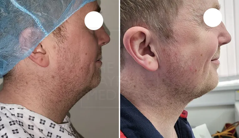 chin liposuction before and after male-1