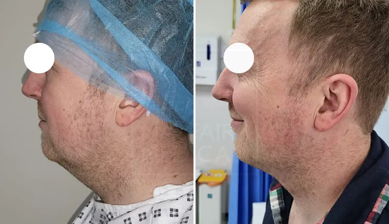 chin liposuction before and after male