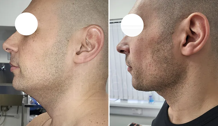 chin liposuction before and after men-1