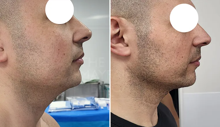 chin liposuction before and after men