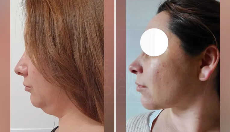chin liposuction before and after patient-1-1