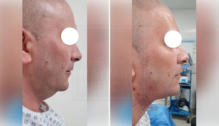 chin liposuction before and after patient-1-2