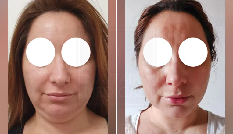 chin liposuction before and after patient-1