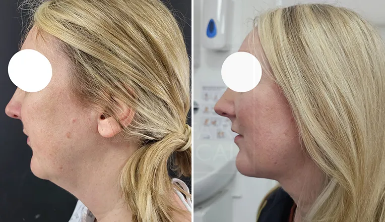 chin liposuction before and after