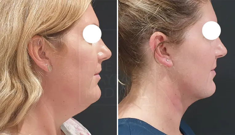 double chin liposuction before and after-1