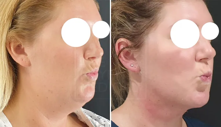 double chin liposuction before and after-2