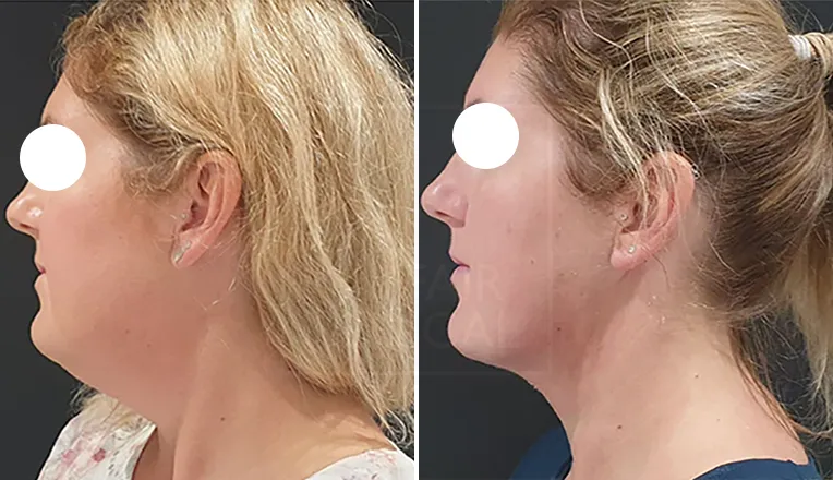 double chin liposuction before and after