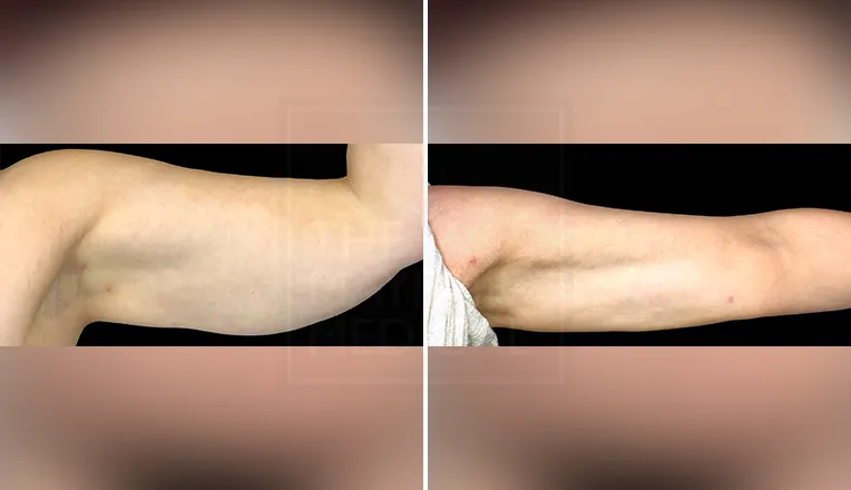 liposuction arms before and after