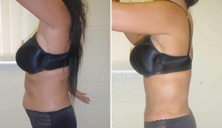 liposuction before and after stomach-1