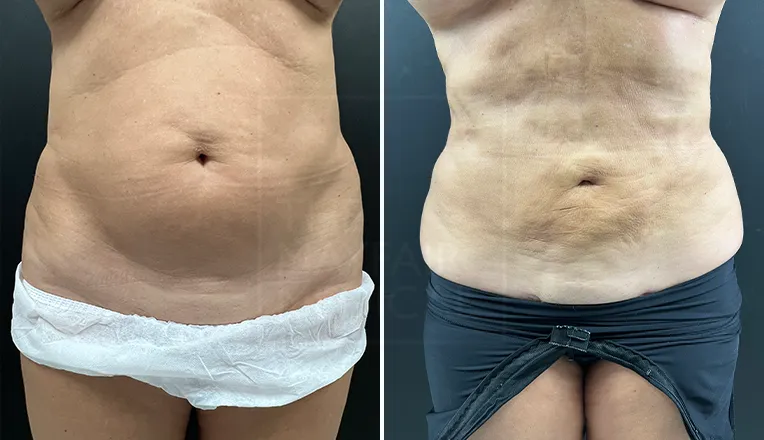 liposuction before and after stomach-3