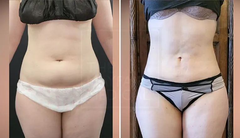 liposuction before and after stomach