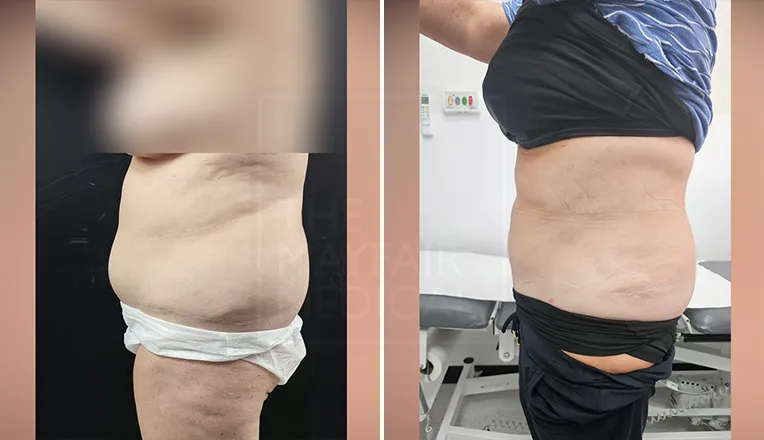 liposuction belly before and after-1