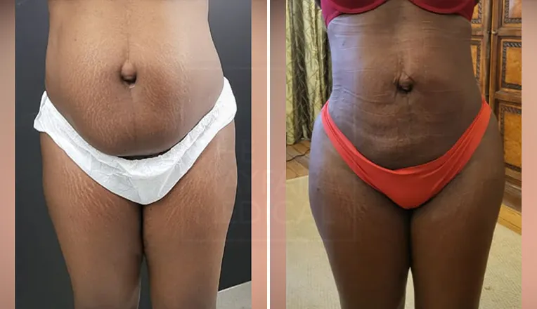 liposuction belly before and after