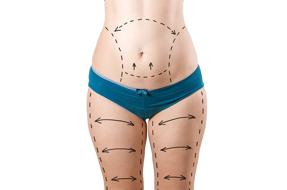 liposuction body areas marking