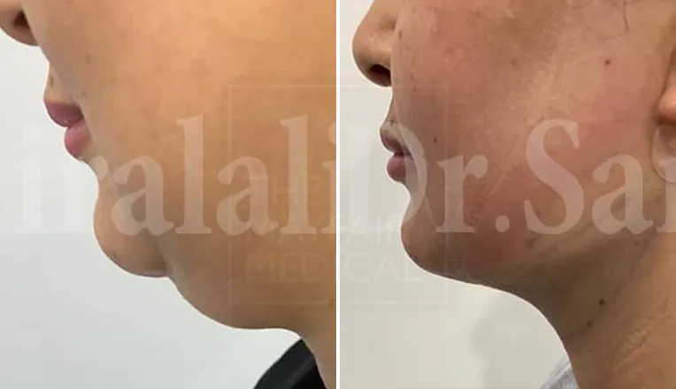 liposuction under chin before and after