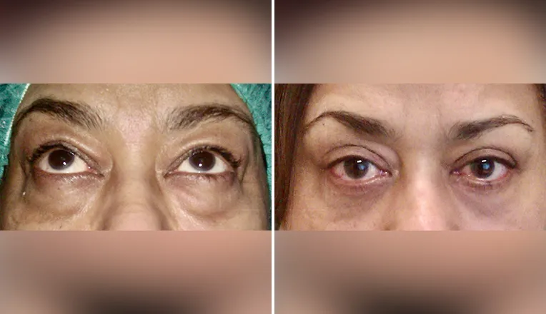 lower blepharoplasty before and after-1